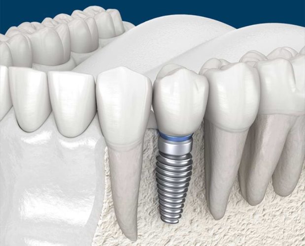 Trồng răng Implant giúp khắc phục các dấu hiệu tiêu xương răng