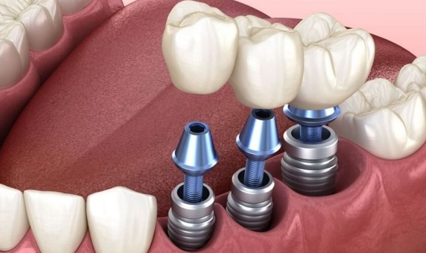Phương pháp cấy ghép Implant
