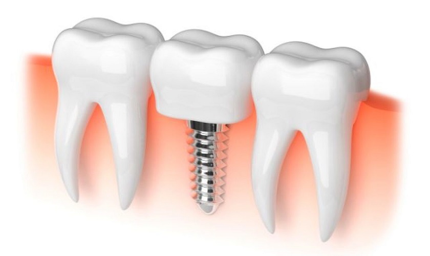 Cắm Implant bao lâu cắt chỉ để đảm bảo an toàn?