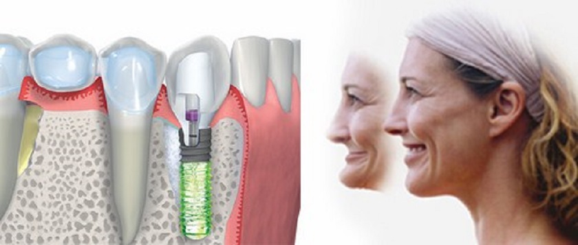 Cấy ghép Implant có cải thiện được tình trạng móm răng không?