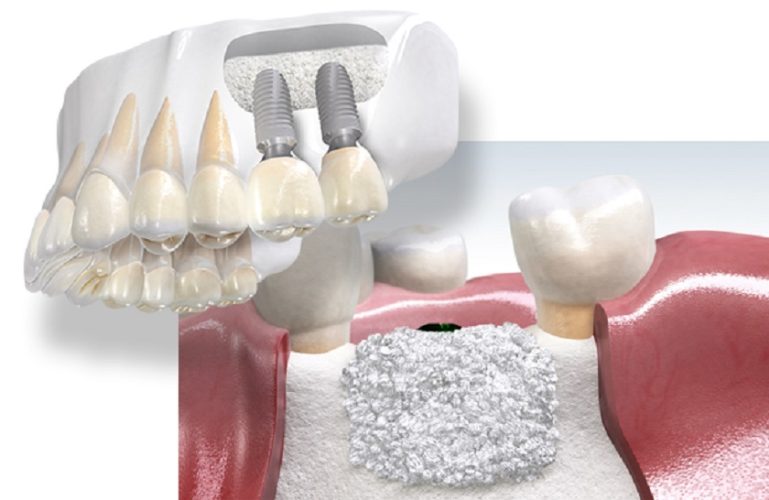 Khách hàng có thể cần ghép thêm xương nếu xương hàm đã tiêu hủy nhiều
