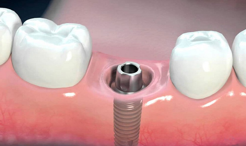 Phương pháp cấy ghép Implant không phẫu thuật lật vạt