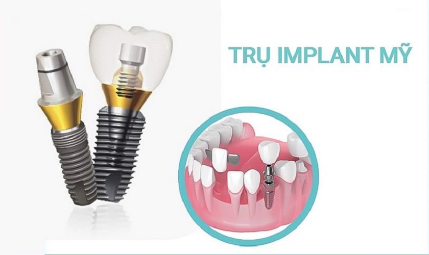 Cấy ghép Implant Mỹ có tốt không? Đặc điểm và giá thành