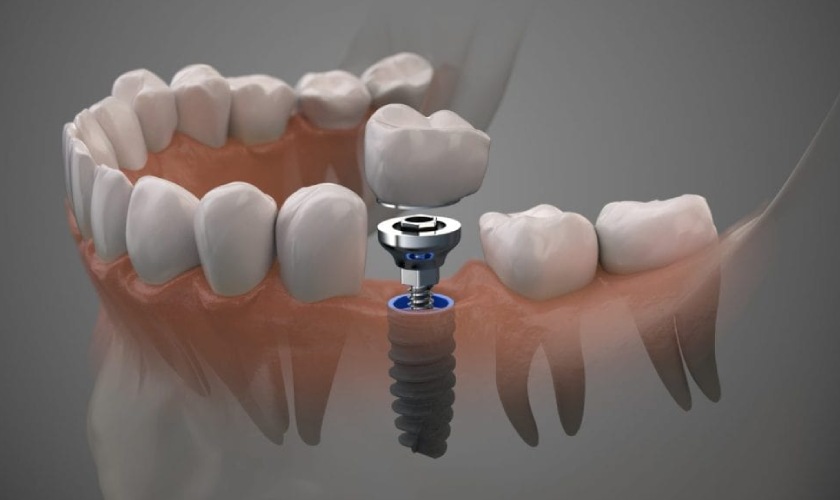 Cấy ghép Implant Mỹ có tốt không?
