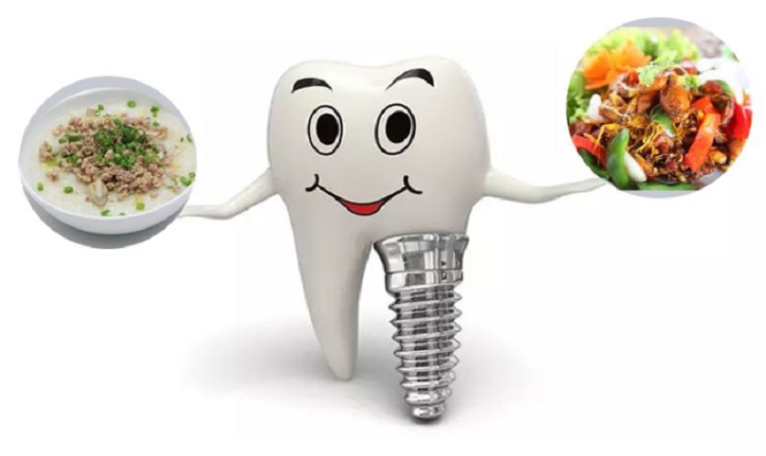 Cấy Implant bao lâu có thể ăn uống lại được?