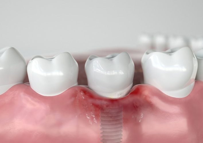 Hút thuốc lá làm tăng nguy cơ viêm nhiễm sau phẫu thuật cấy ghép Implant