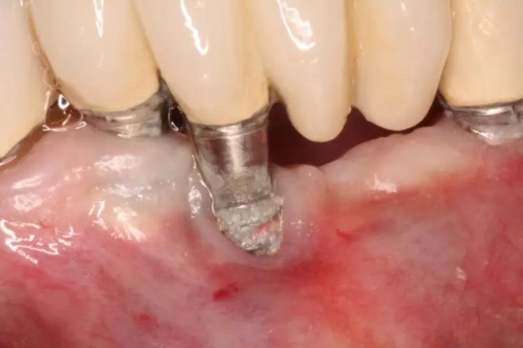 Hút thuốc lá làm tăng nguy cơ đào thải trụ Implant