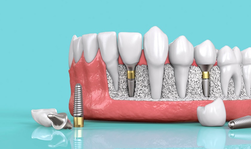Tại sao nên phục hình Implant khi mất nhiều răng?