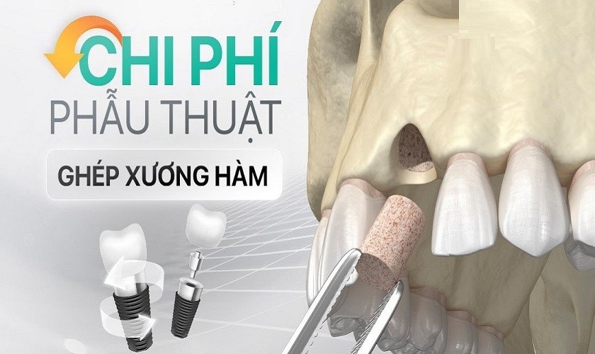 Chi phí ghép xương trong trồng răng Implant là bao nhiêu?
