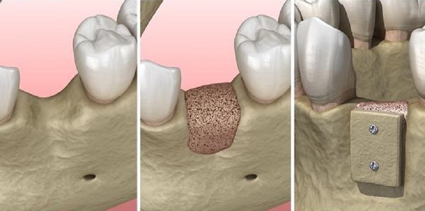 Ghép xương trong trồng răng Implant