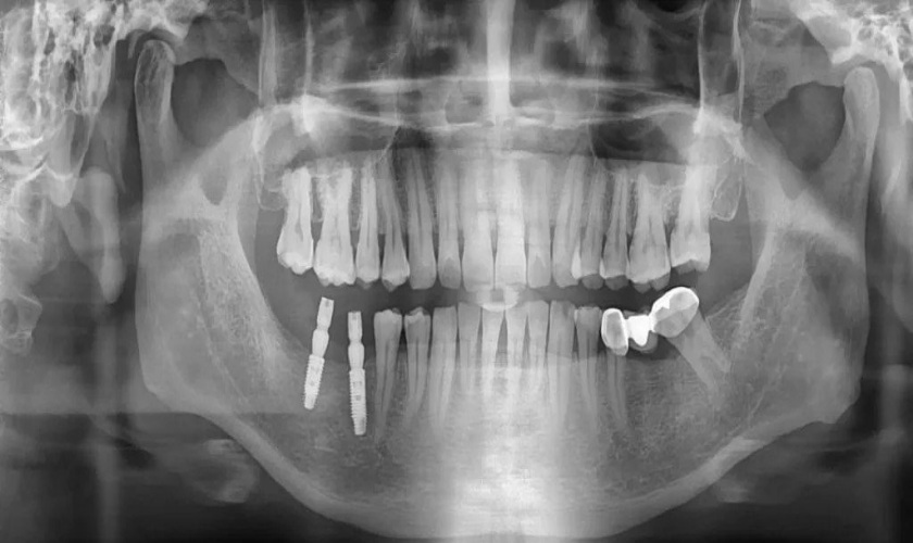 Hình ảnh phim thu được khi chụp X quang răng toàn cảnh