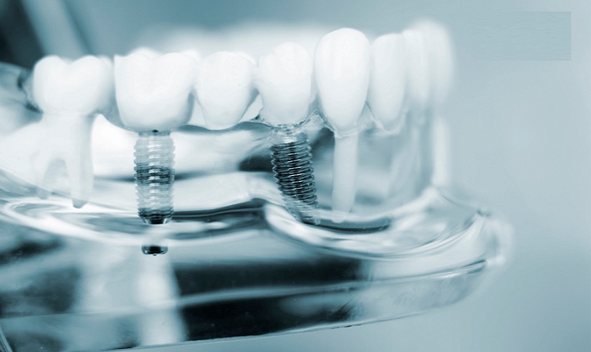 Có nên trồng răng Implant không? Lời khuyên từ chuyên gia