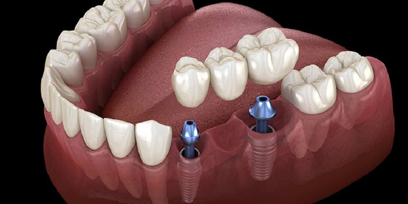 Có nên trồng răng Implant không?