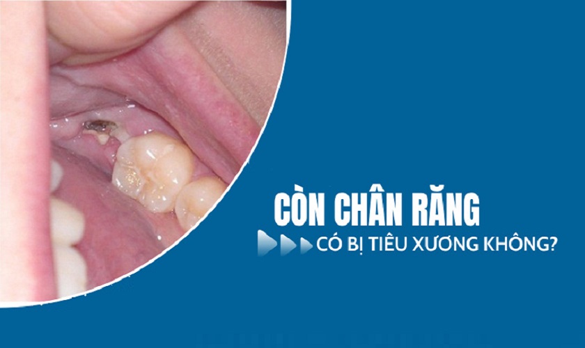 Còn chân răng có bị tiêu xương không?