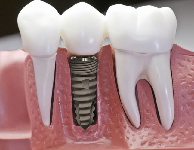 Công nghệ từ tính rút ngắn thời gian cấy ghép Implant và hạn chế sang chấn