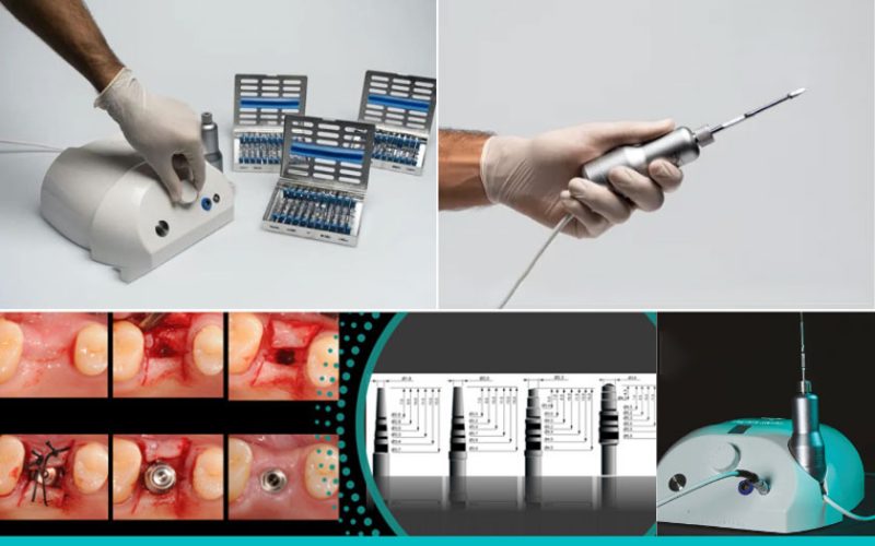 Công nghệ từ tính giúp bảo tồn xương và mô mềm xung quanh vị trí cấy ghép Implant