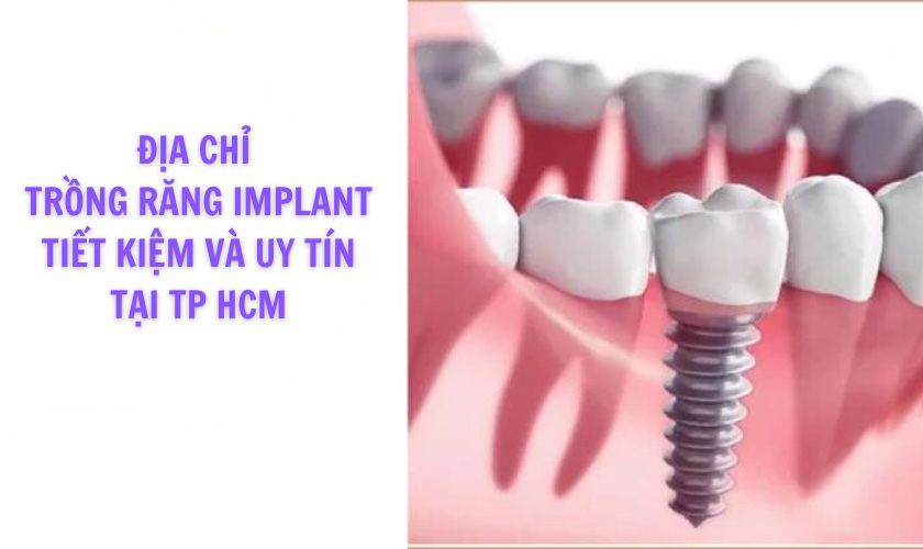 Địa chỉ trồng răng Implant tiết kiệm, an toàn tại TP HCM