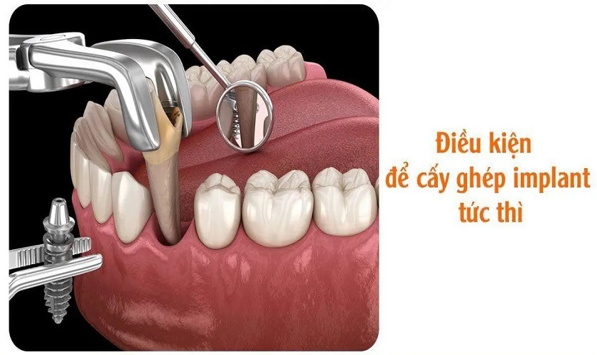 Lợi ích đem lại và điều kiện để cấy ghép Implant tức thì