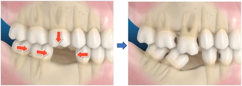 Hàm răng có thể bị xô lệch nếu không phục hình răng sớm