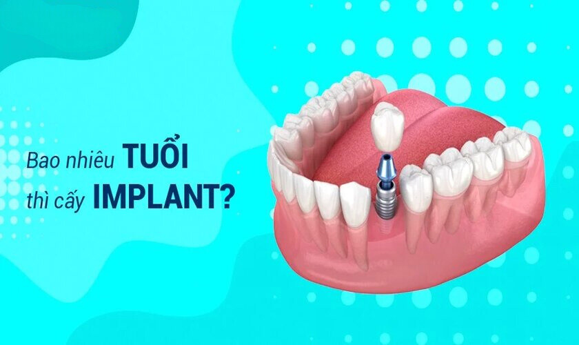 Độ tuổi trồng răng Implant tốt nhất bạn đã biết chưa?