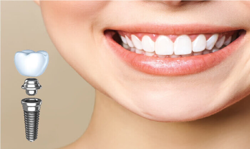 Sau 18 tuổi là độ tuổi trồng răng Implant tốt nhất