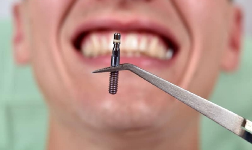 Gắn Implant để làm gì? Lợi ích khi gắn Implant