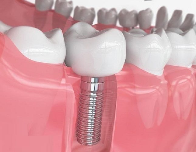 Kỹ thuật gắn Implant trong phục hình nha khoa