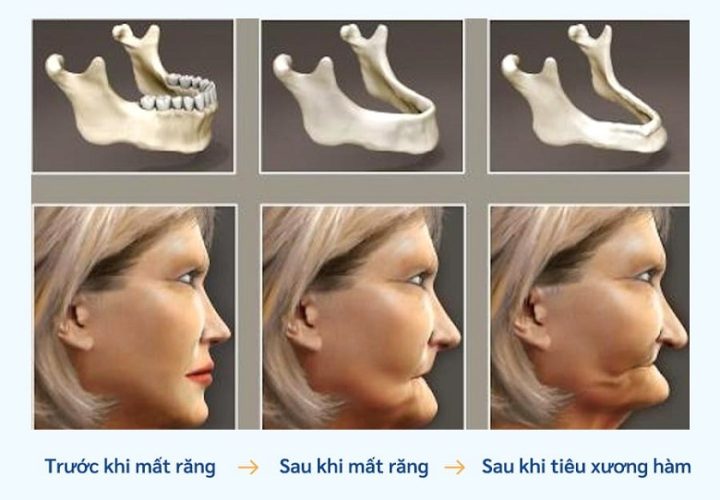 Sự thoái hóa xương hàm và biến đổi cấu trúc gương mặt sau khi mất răng lâu ngày không được phục hình