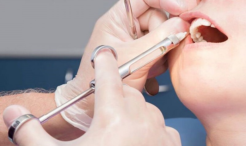 Nên thực hiện gây tê hay gây mê trong trồng răng Implant?