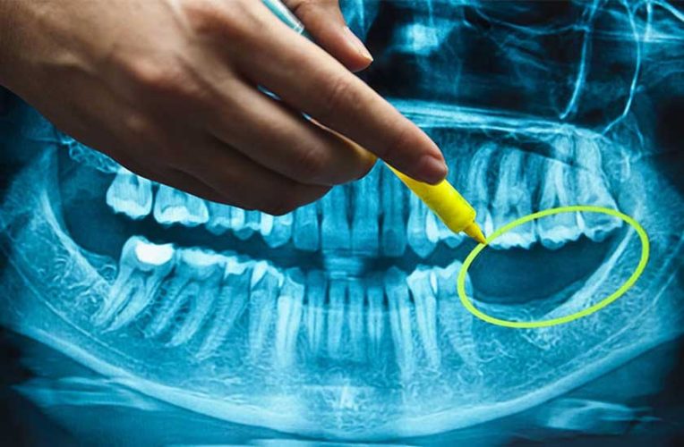 Vùng xương hàm bị tiêu biến do mất răng