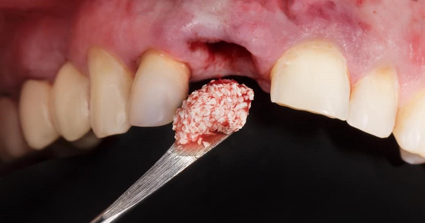 Ghép xương trong trồng răng Implant