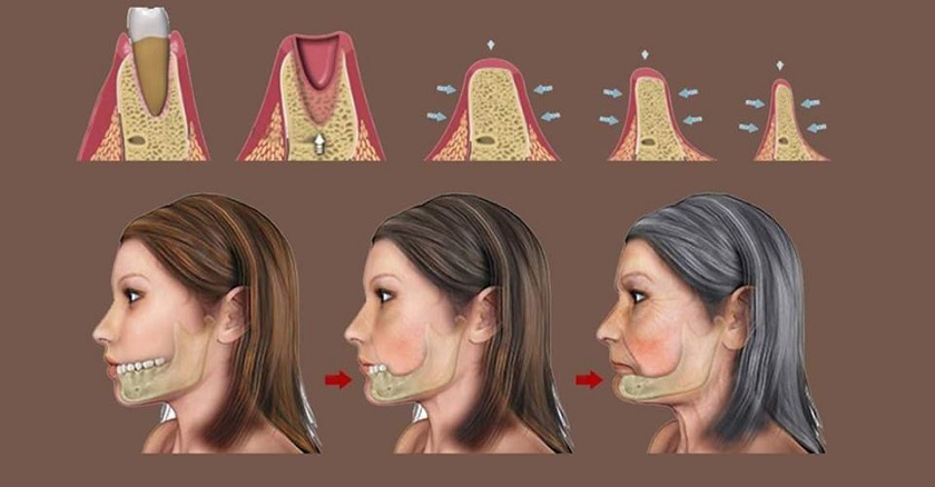 Đeo hàm tháo lắp lâu năm sẽ khiến xương hàm tiêu hõm