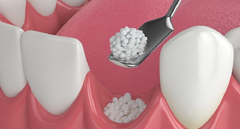 Ghép thêm xương để đặt Implant trong trường hợp tiêu xương nhiều