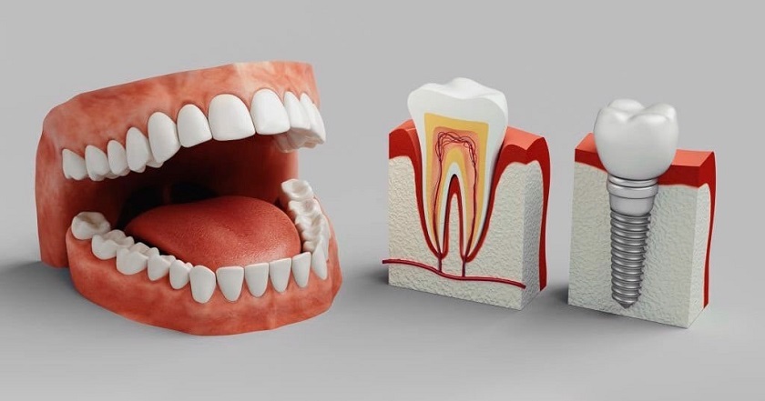 Cấy ghép Implant là giải pháp thích hợp nhất giúp khắc phục hiện tượng già đi do mất răng lâu năm