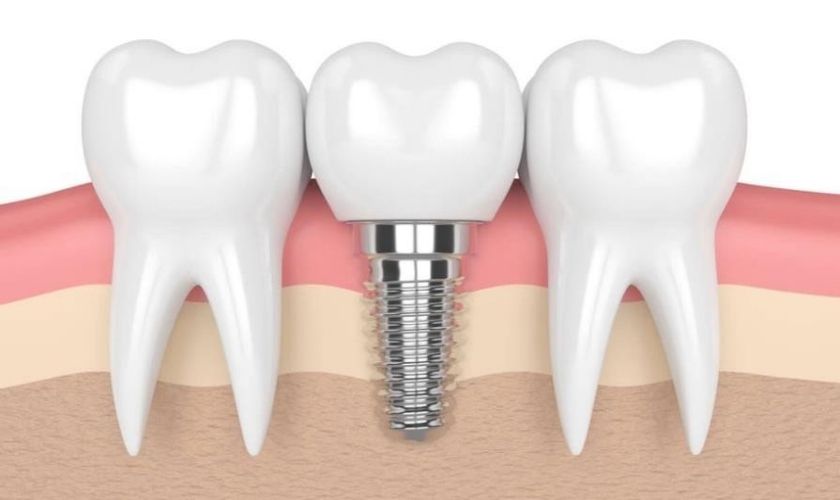 Nguyên nhân giắt thức ăn bên dưới phục hình Implant