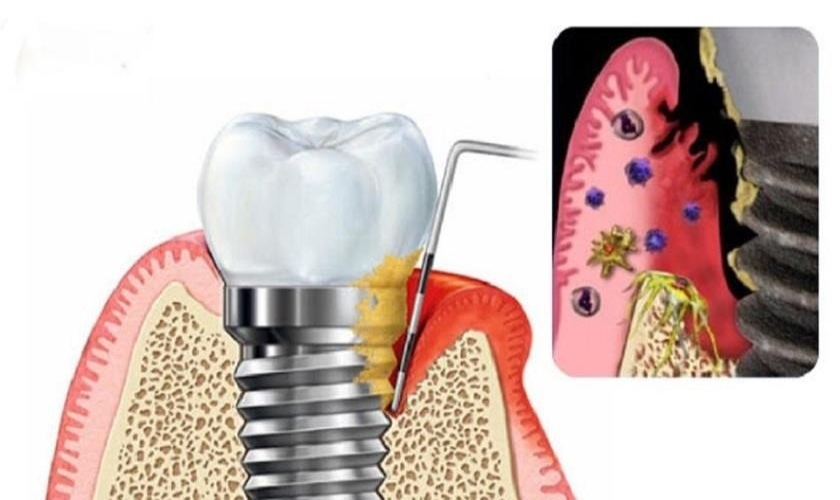 Răng bị viêm do giắt thức ăn bên dưới Implant lâu ngày