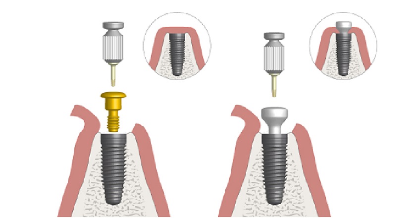 Độ ổn định và tương thích của Implant với xương là yếu tố quyết định thời gian gắn Healing Cap