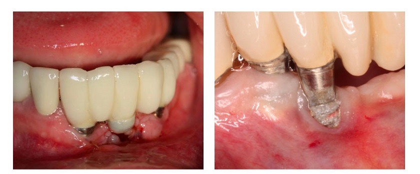 Hối hận khi trồng răng Implant chất lượng kém khiến Implant bị đào thải