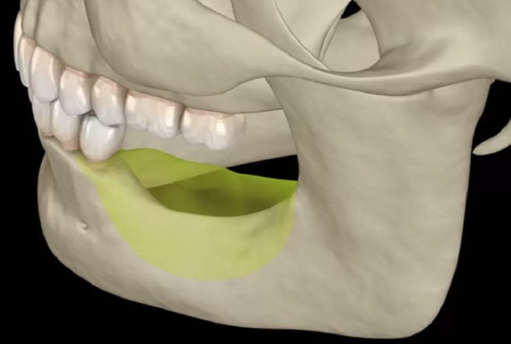 Xương hàm tiêu biến nặng nề do không trồng răng Implant sớm