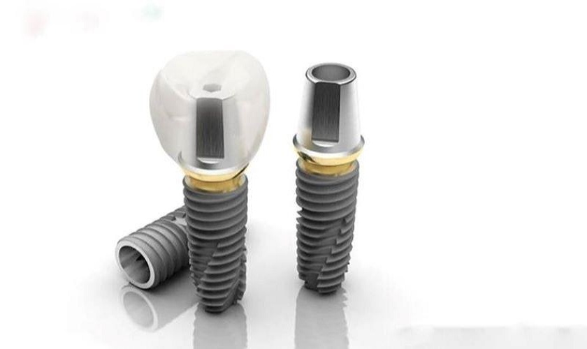 Trụ Implant Hàn Quốc có tốt không?