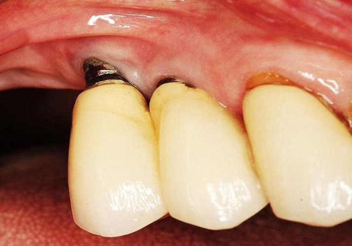 Biểu hiện đào thải trụ Implant