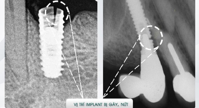 Trụ Implant bị nứt, gãy vỡ trong xương hàm