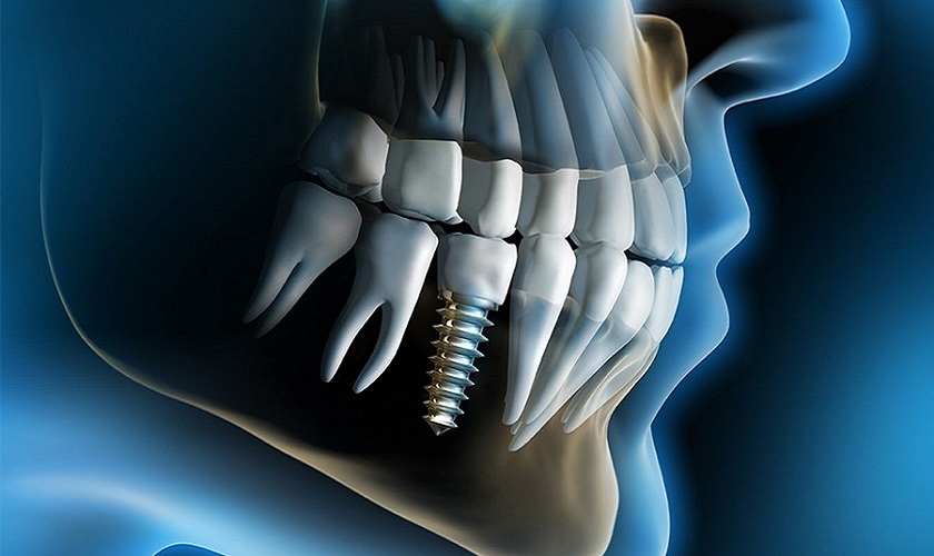 Các triệu chứng sau cấy Implant và cách xử lý