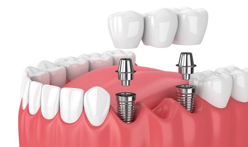 Implant nâng đỡ cầu răng và những điều bạn cần biết