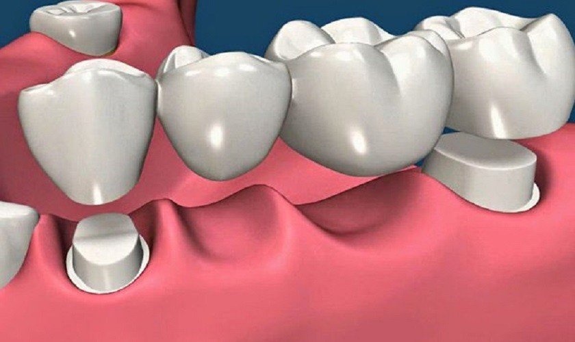 Làm cầu răng sứ bị tiêu xương phải làm sao?