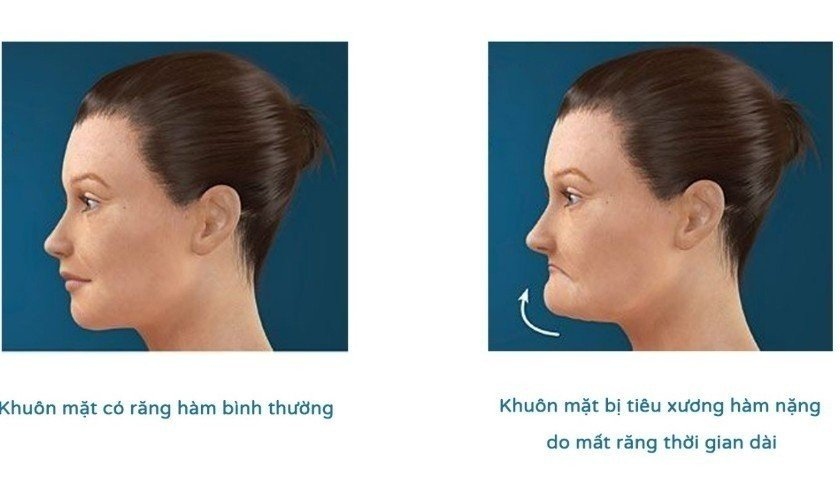 Làm cầu răng sứ bị tiêu xương ảnh hưởng đến chất lượng cuộc sống