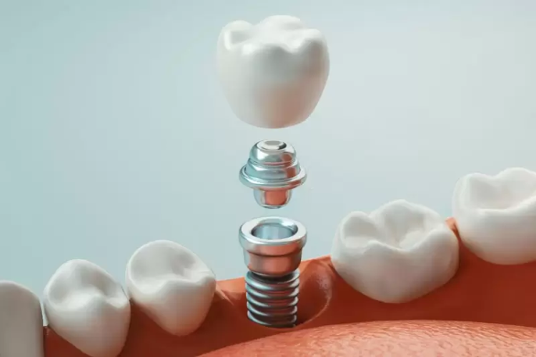 Cấy ghép implant giúp ngăn ngừa tiêu xương hàm hiệu quả