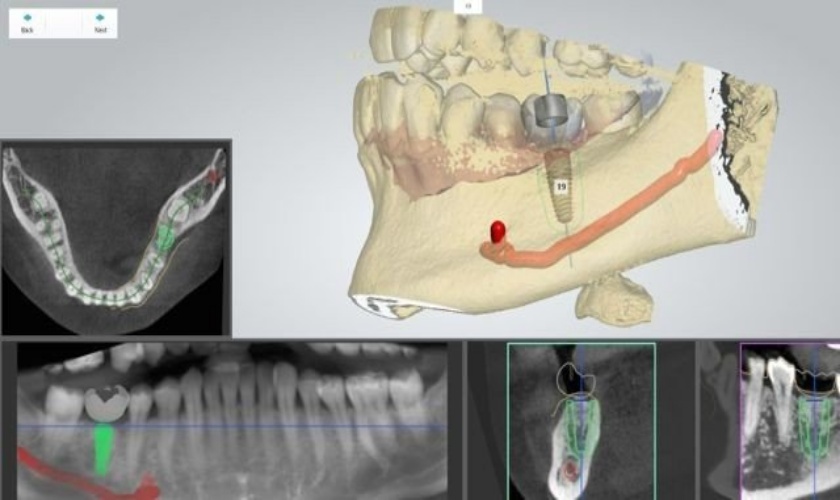 Máng hướng dẫn phẫu thuật cấy ghép Implant hỗ trợ đắc lực cho bác sĩ trong quá trình lập kế hoạch điều trị