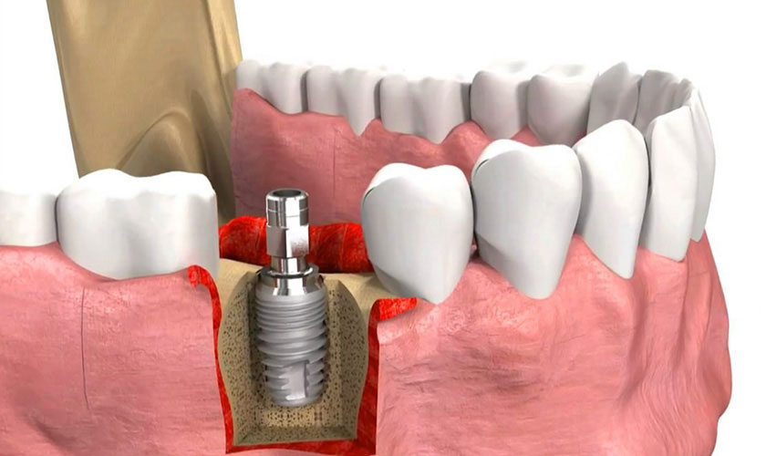 Cấy ghép Implant - Giải pháp phục hình răng hàm tối ưu nhất hiện nay