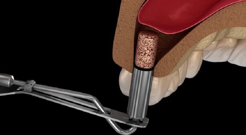 Nâng xoang ghép xương trong phục hình răng Implant